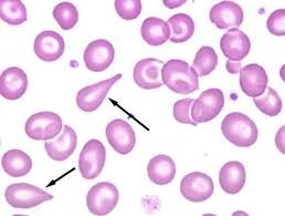 Dacrocytes